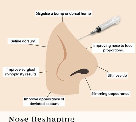 PDO Thread Lift Nose Manila: A Comprehensive Guide 