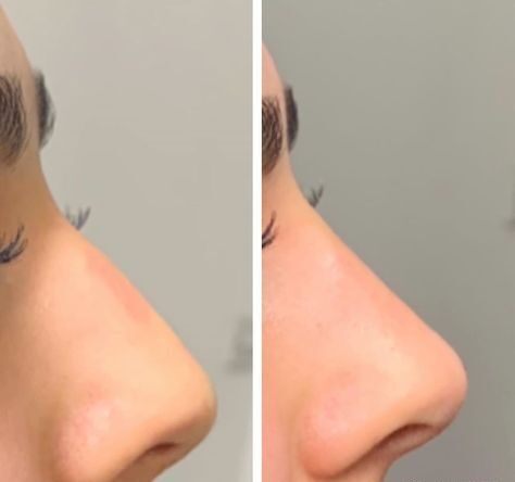 PDO Thread Lift Nose Manila: A Comprehensive Guide