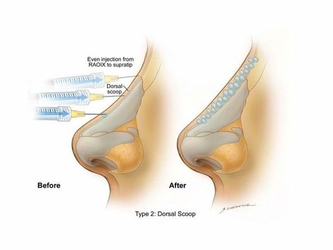 PDO Thread Lift Nose Manila: A Comprehensive Guide 