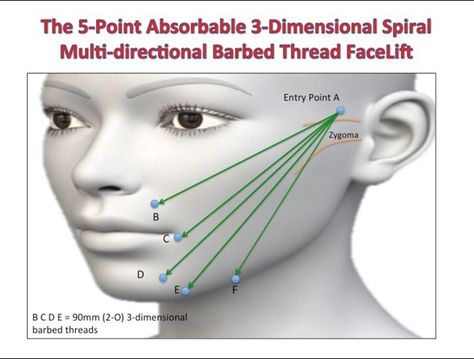  PDO Thread Sticking Out of Face Manila