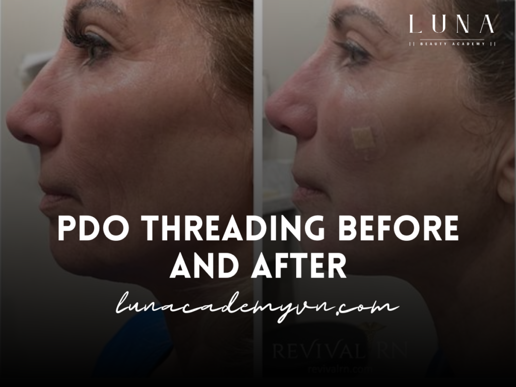 PDO Threading Before and After: This Revolutionary Skin Treatment