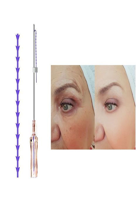 PDO Threads Double Chin Treatment