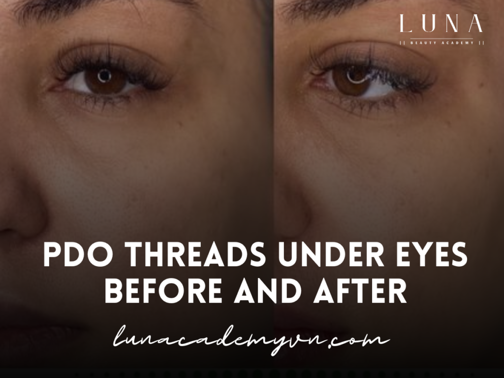 PDO Threads Under Eyes Before and After