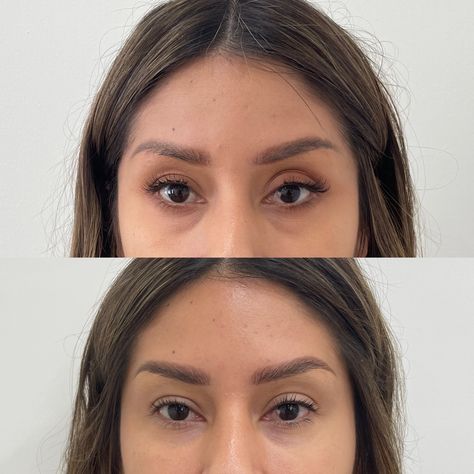 PDO Threads Under Eyes Before and After