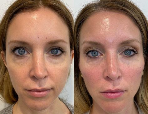 PDO Threads Under Eyes Before and After