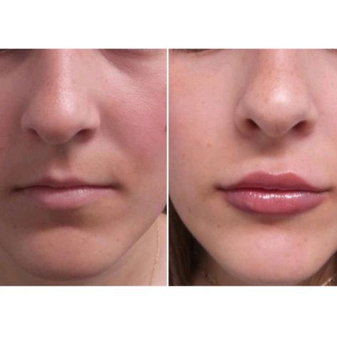 Realistic 1ml Lip Filler Before and After Thin Lips