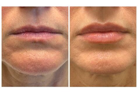 Realistic 1ml Lip Filler Before and After Thin Lips