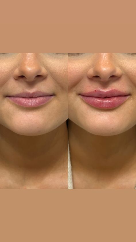 Realistic 1ml Lip Filler Before and After Thin Lips