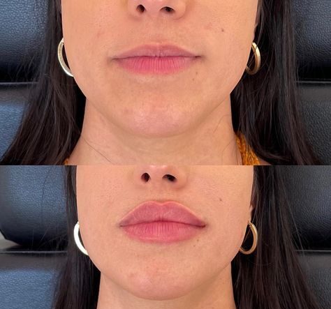 Realistic 1ml Lip Filler Before and After Thin Lips