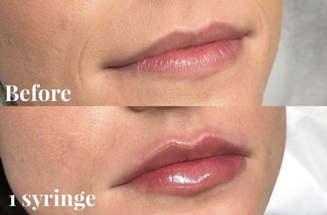 Realistic 1ml Lip Filler Before and After Thin Lips