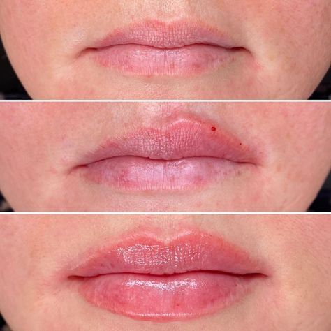 Realistic 1ml Lip Filler Before and After Thin Lips