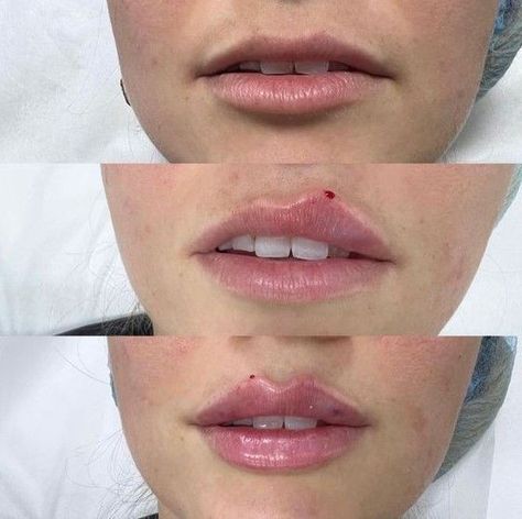 Realistic 1ml Lip Filler Before and After Thin Lips