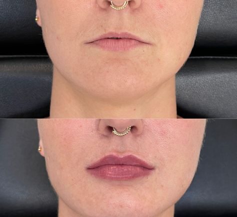 Realistic 1ml Lip Filler Before and After Thin Lips