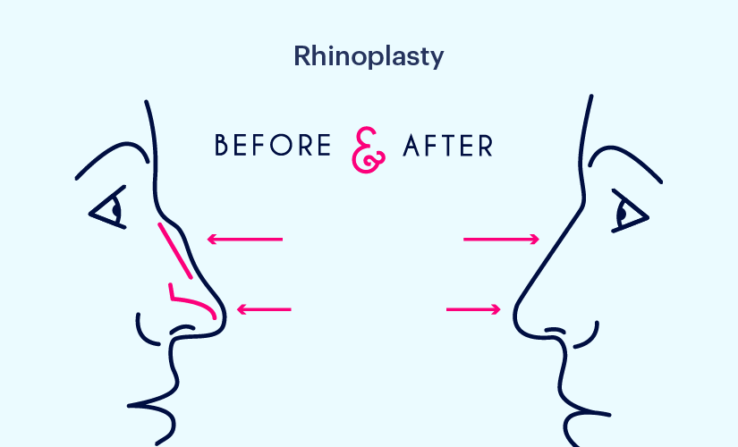 rhinoplasty before and after