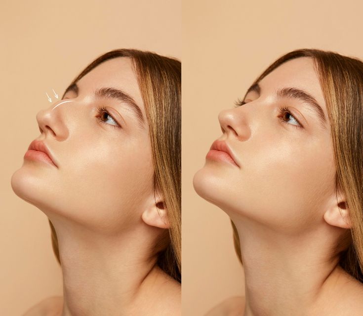 Rhinoplasty Cost in Manila