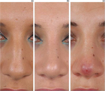 Long-Term Side Effects of Rhinoplasty