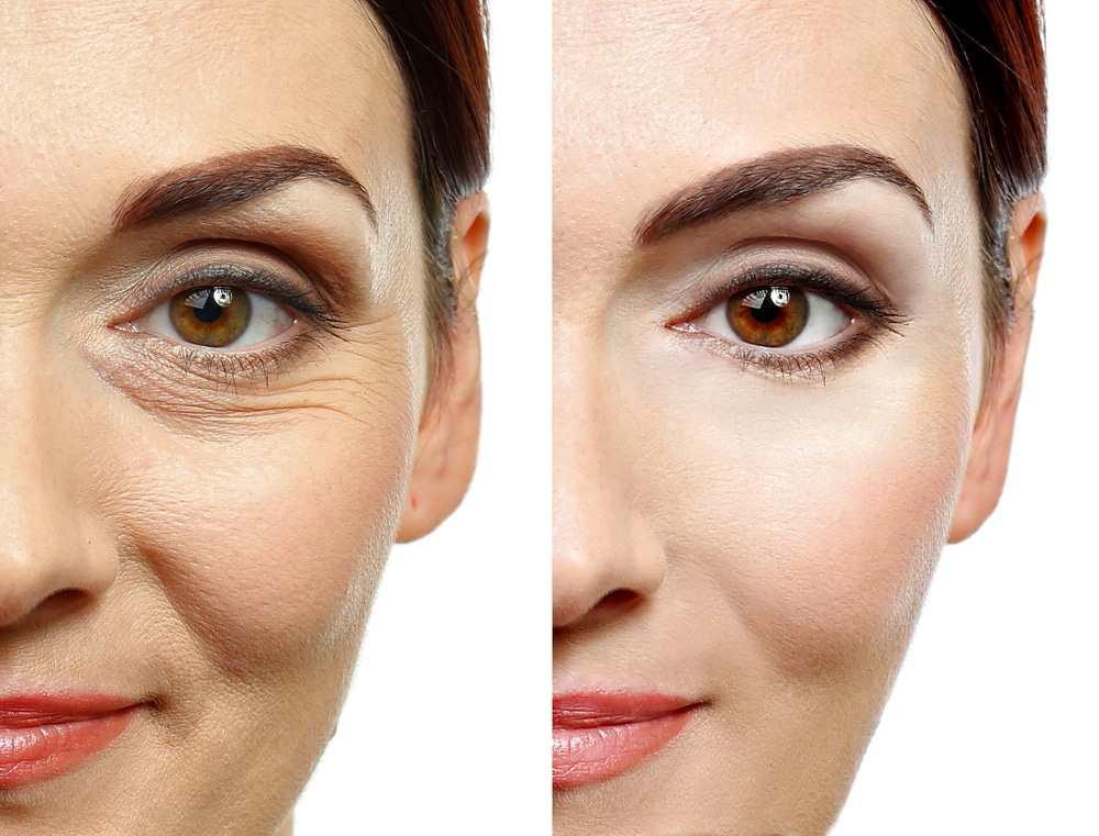 signs-and-symptoms-of-under-eye-wrinkles