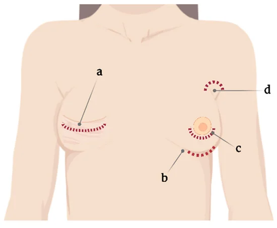 solutions-for-addressing-concerns-about-breast-augmentation