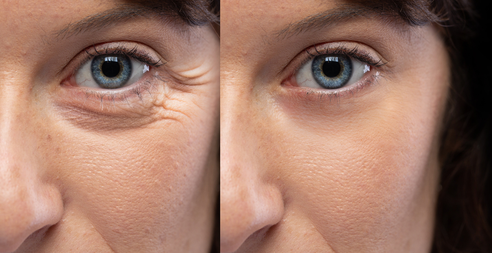 the-benefits-of-botox-for-crows-feet