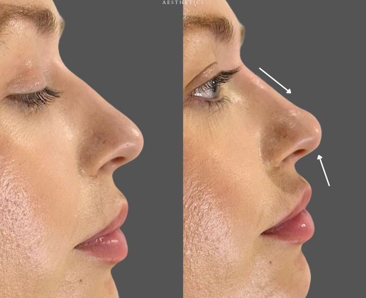 The Benefits of Nose Fillers