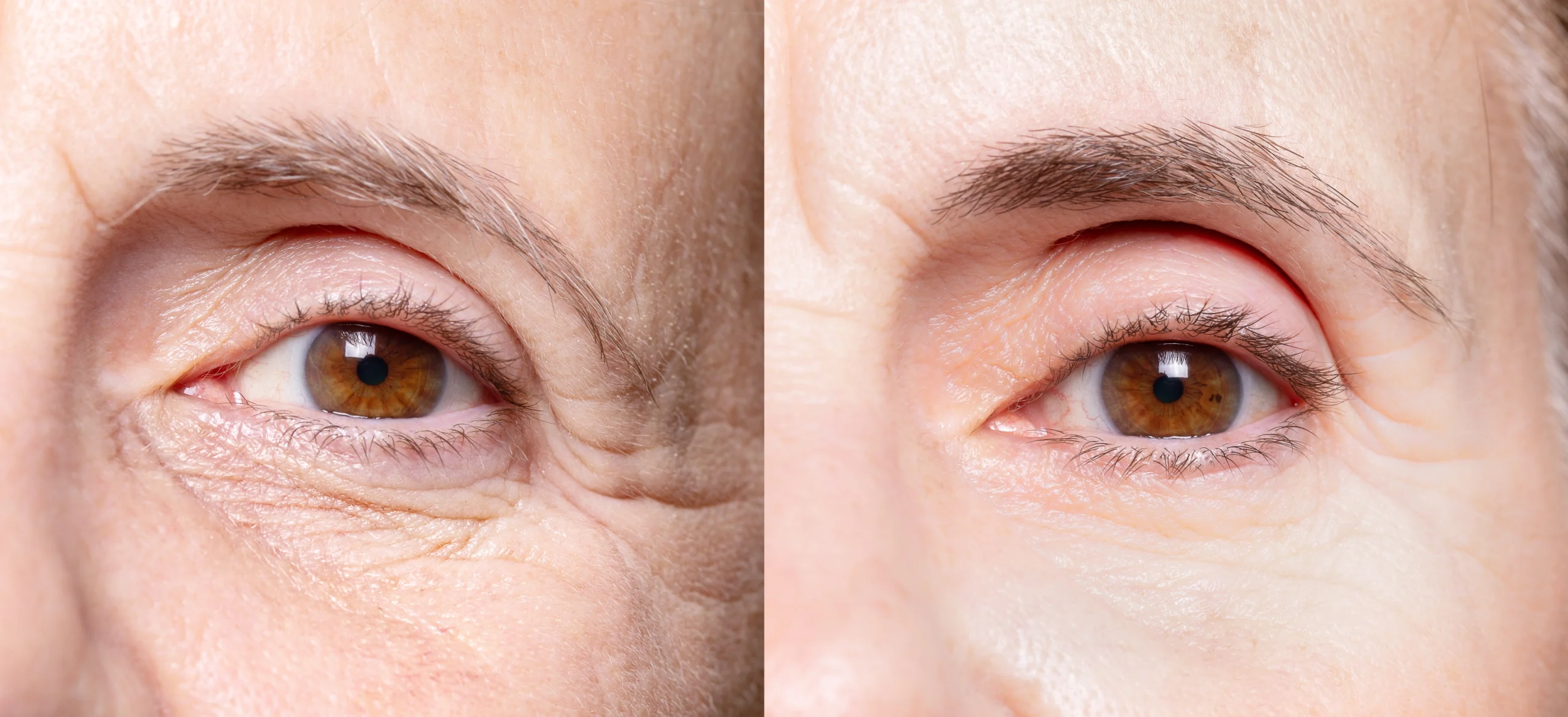 treatment-options-for-under-eye-wrinkles