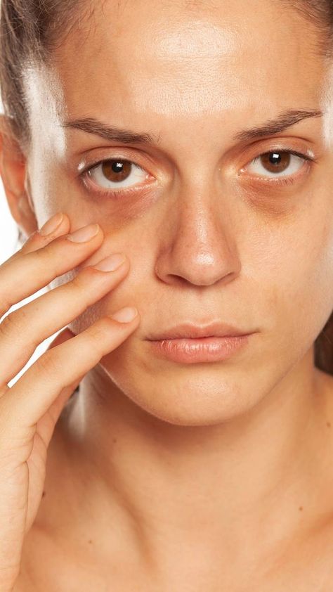 Under Eye Filler Cost Manila: Everything You Need to Know