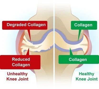 Understanding Collagen and Its Role in Joint Health