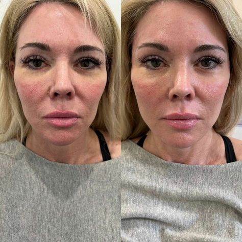 What Happens If You Get Too Much Filler Manila?