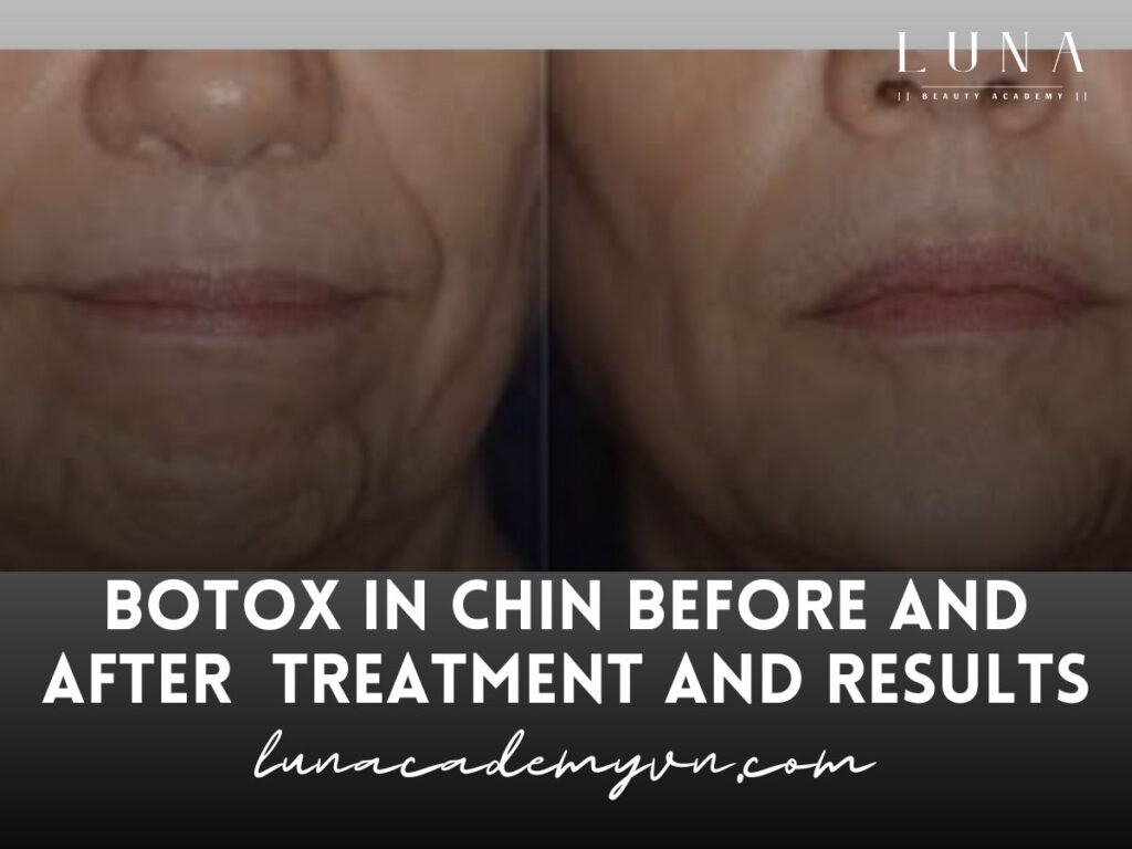 Botox in Chin Before and After Treatment and Results