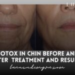 Botox in Chin Before and After –  Treatment and Results