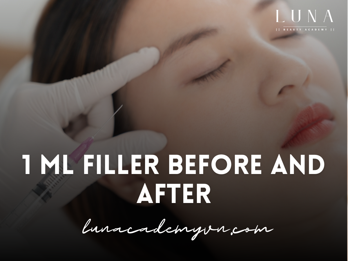 1-ml-filler-before-and-after