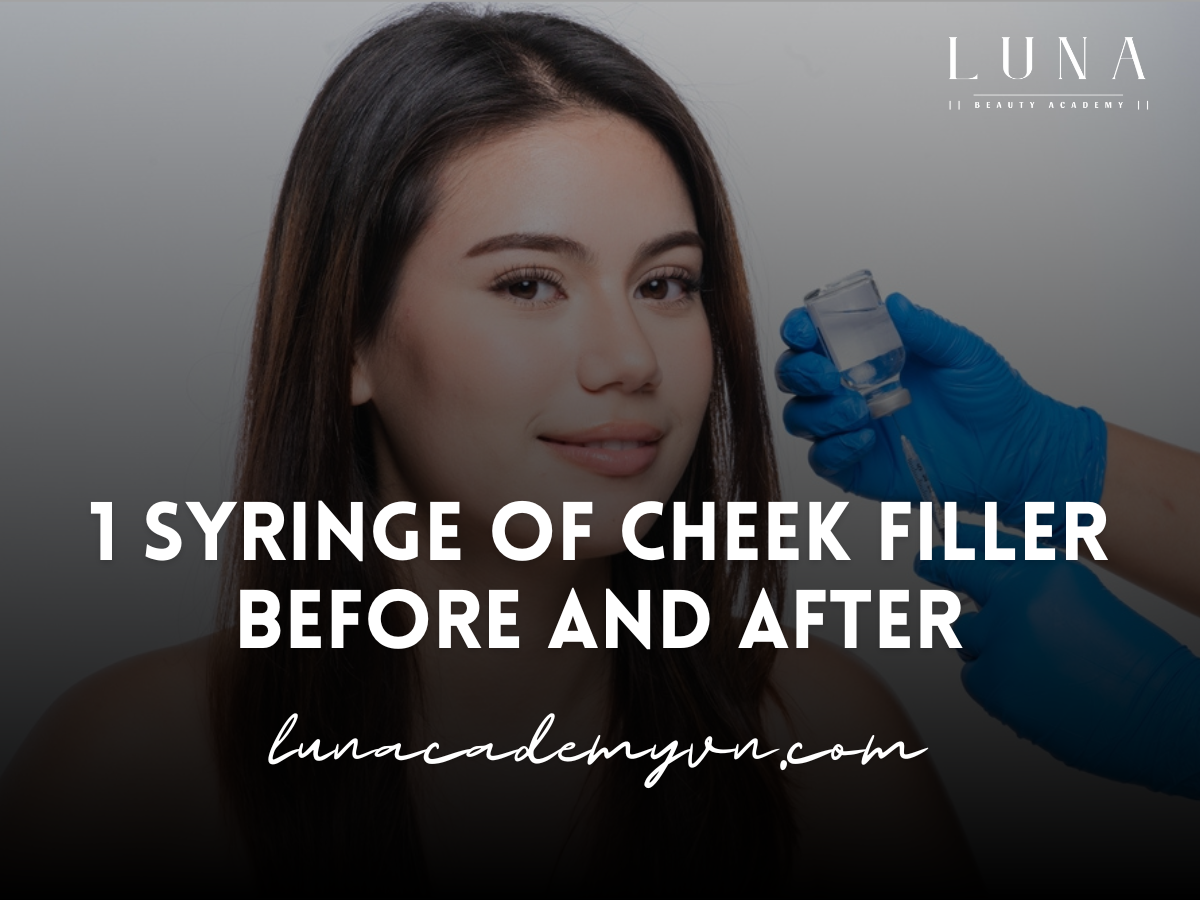 1 Syringe of Cheek Filler Before and After