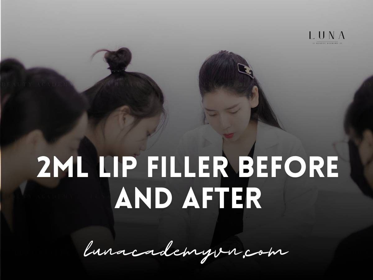 2ml lip filler