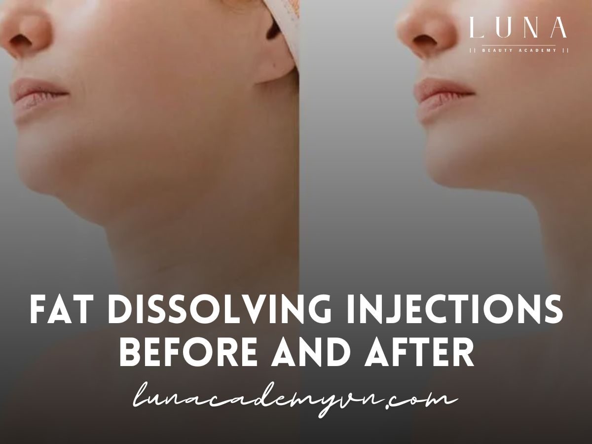 Fat Dissolving Injections Before and After