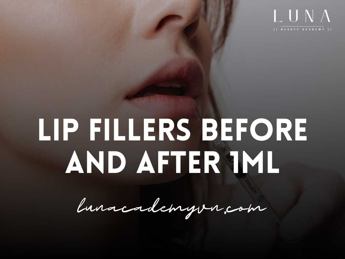 Lip Fillers Before and After 1ml