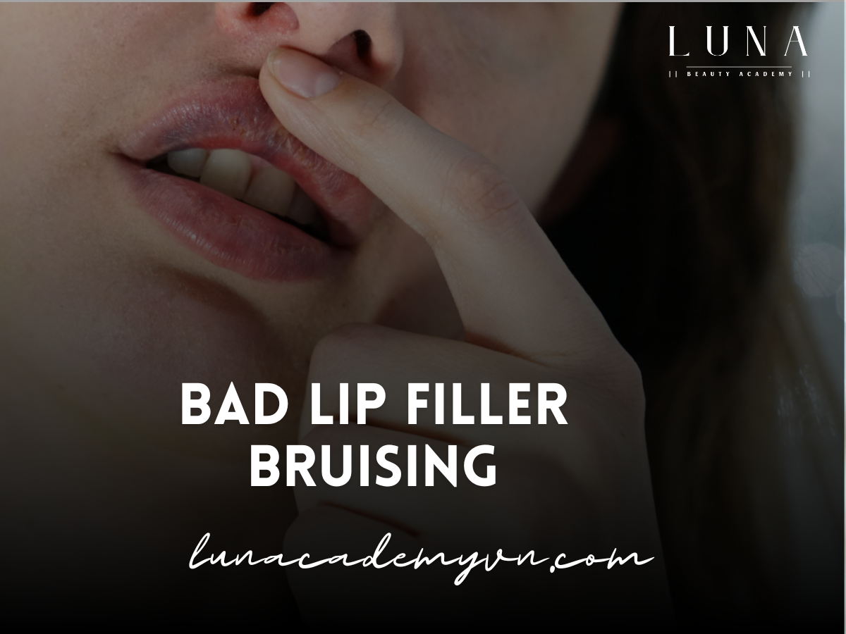 bad lip filler bruising