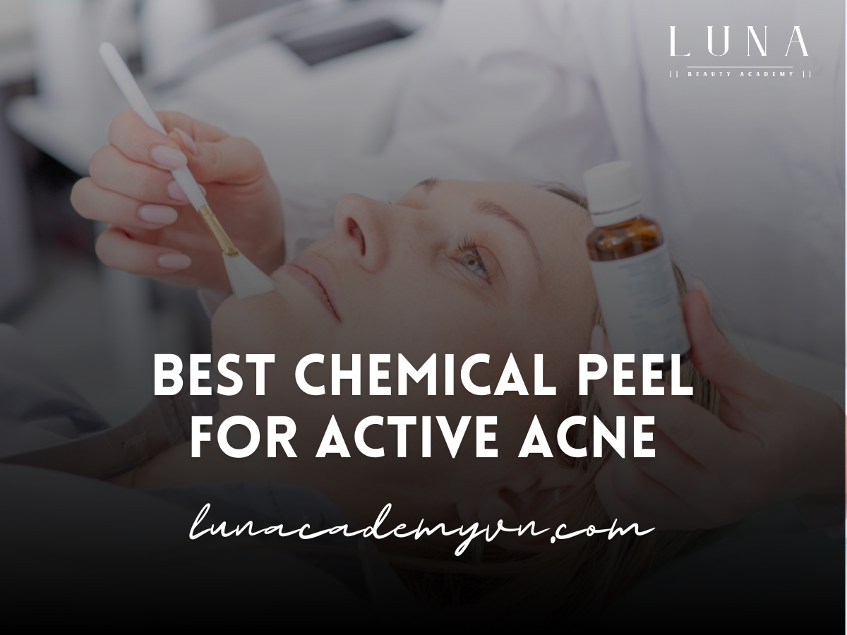 Best Chemical Peel for Active Acne