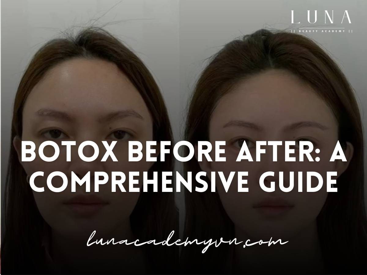 botox before after