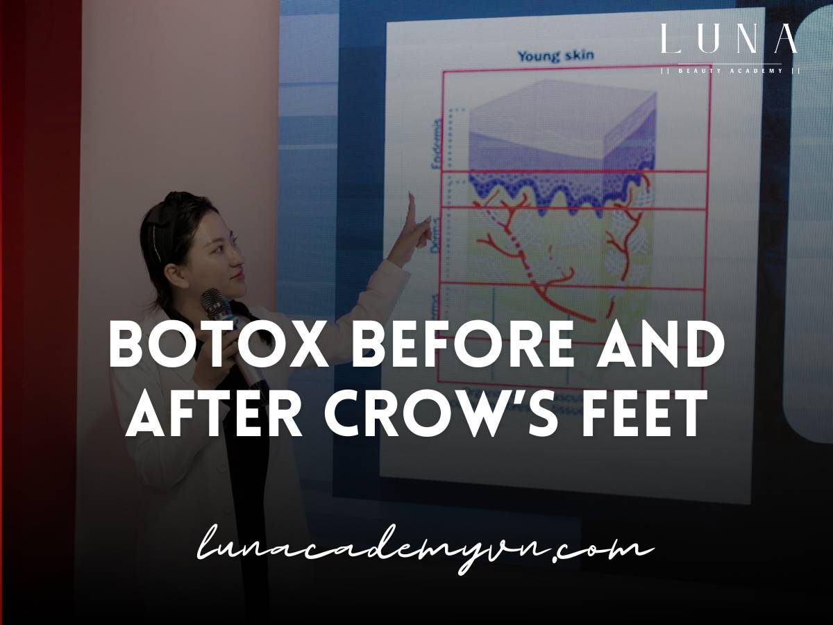 botox before and after crow's feet