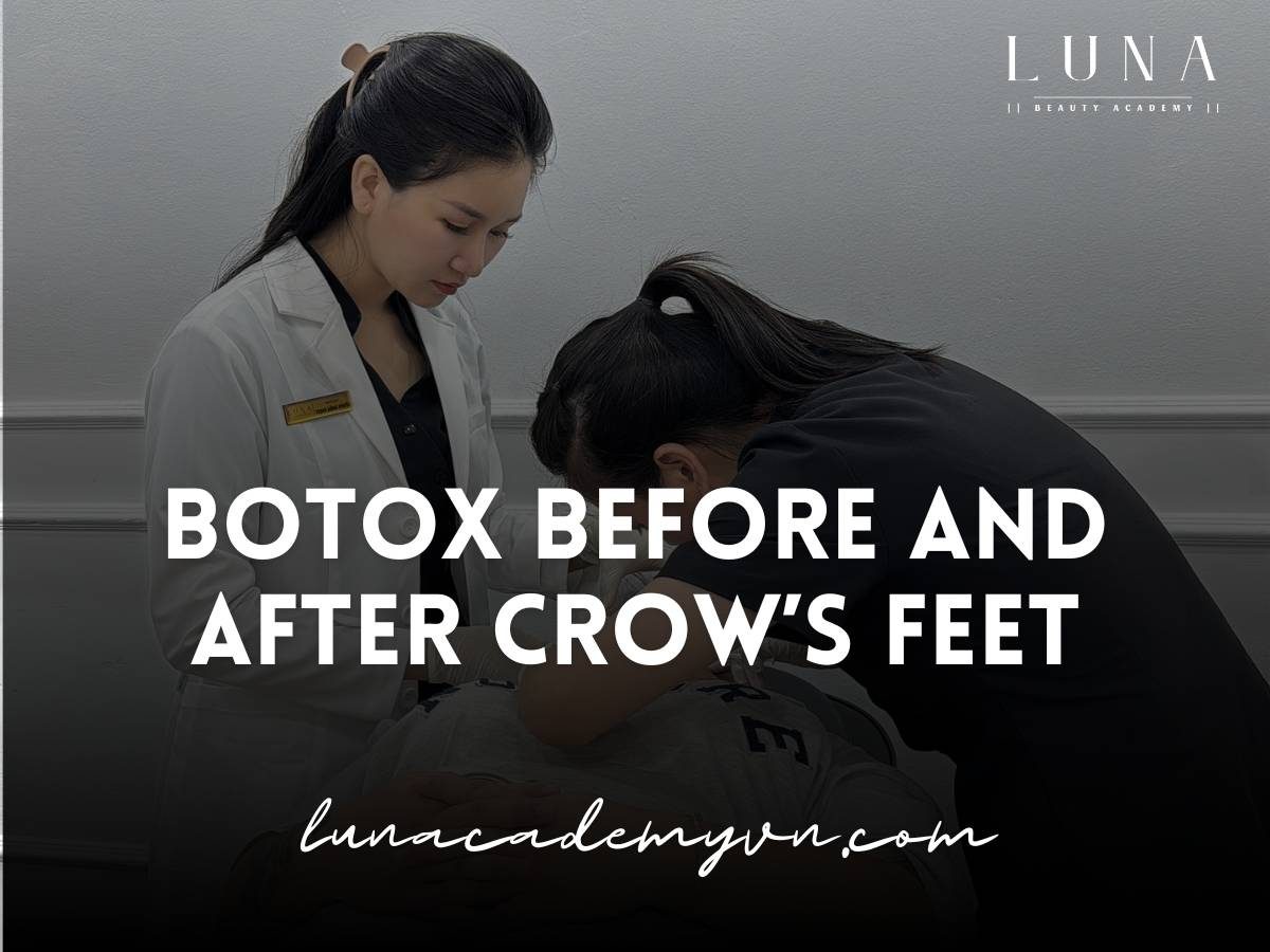 what not to do after botox