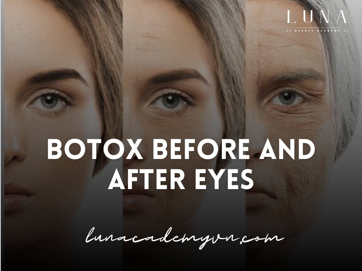 botox before and after eyes