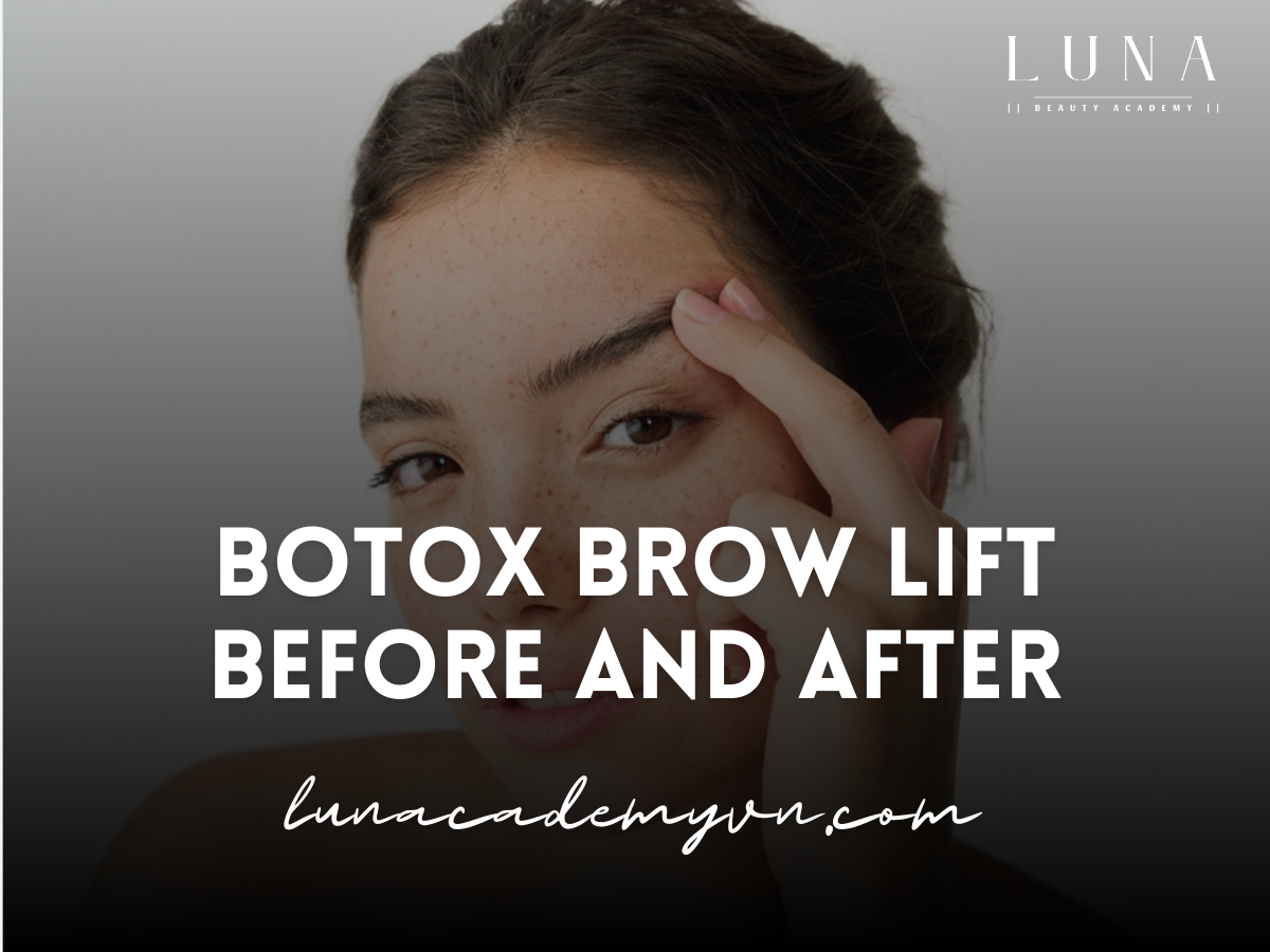 Botox Brow Lift Before and After