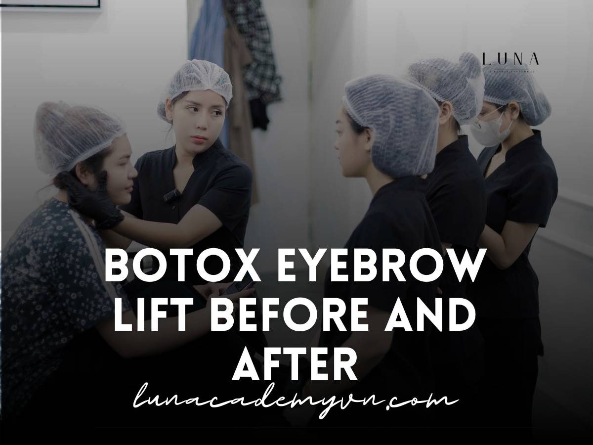 Botox Eyebrow Lift Before and After