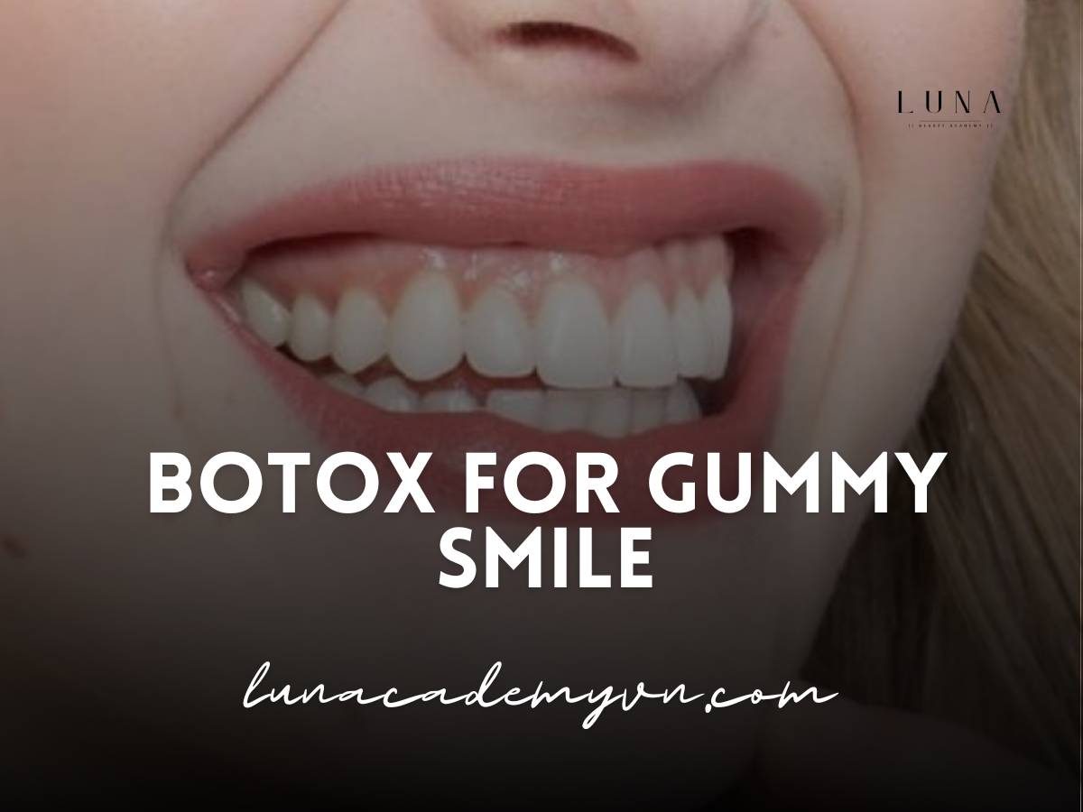 botox for gummy smile