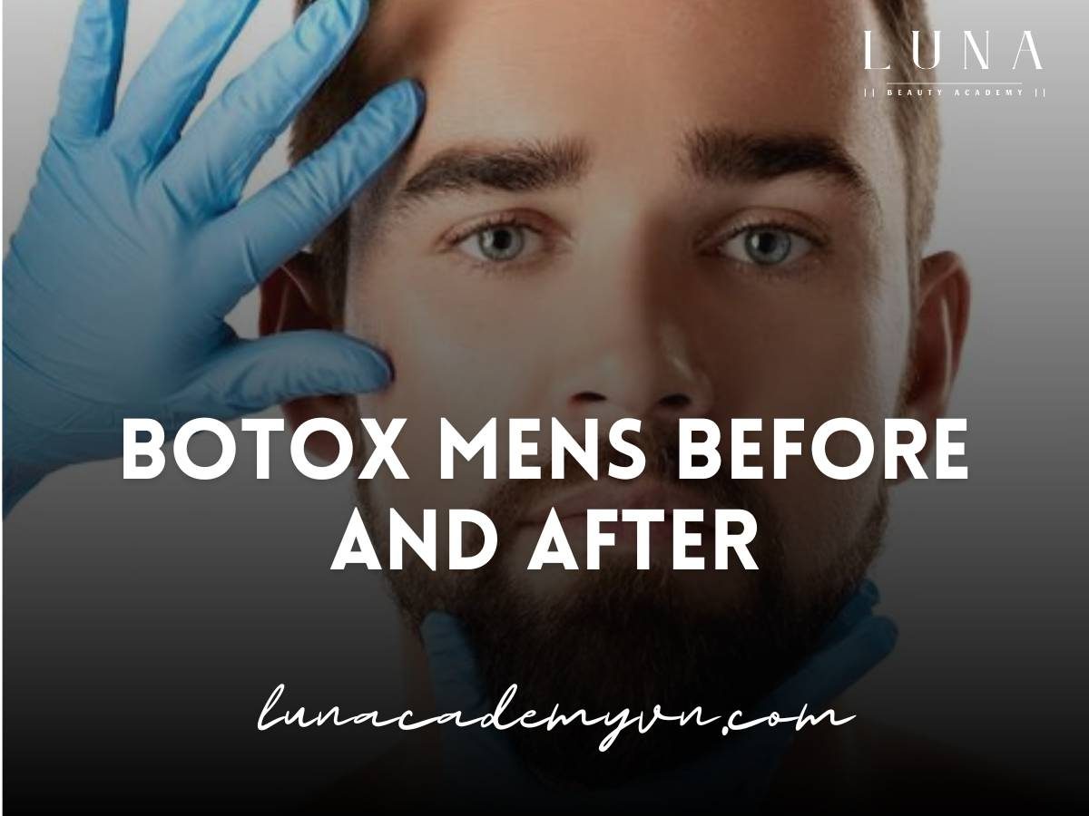 botox mens before and after