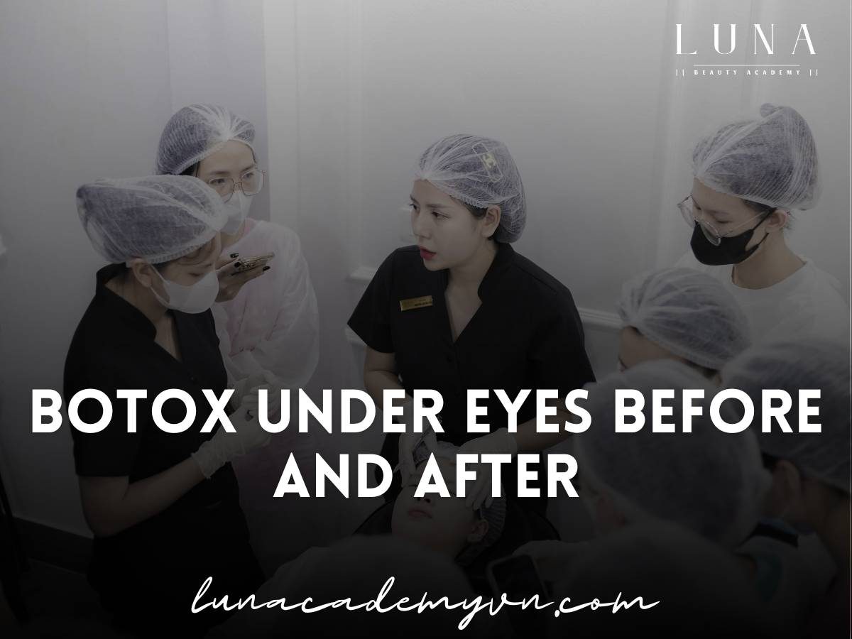 botox under eyes before and after