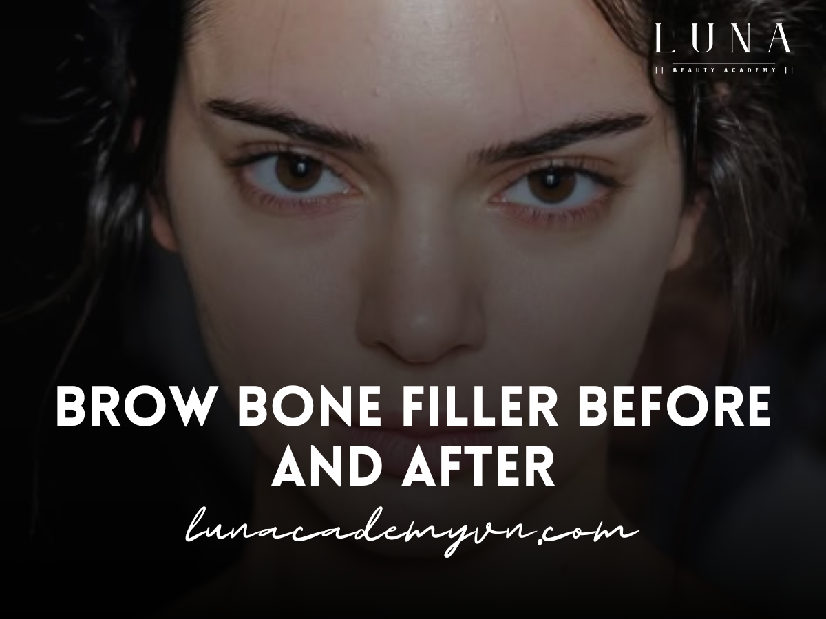 Brow Bone Filler Before and After