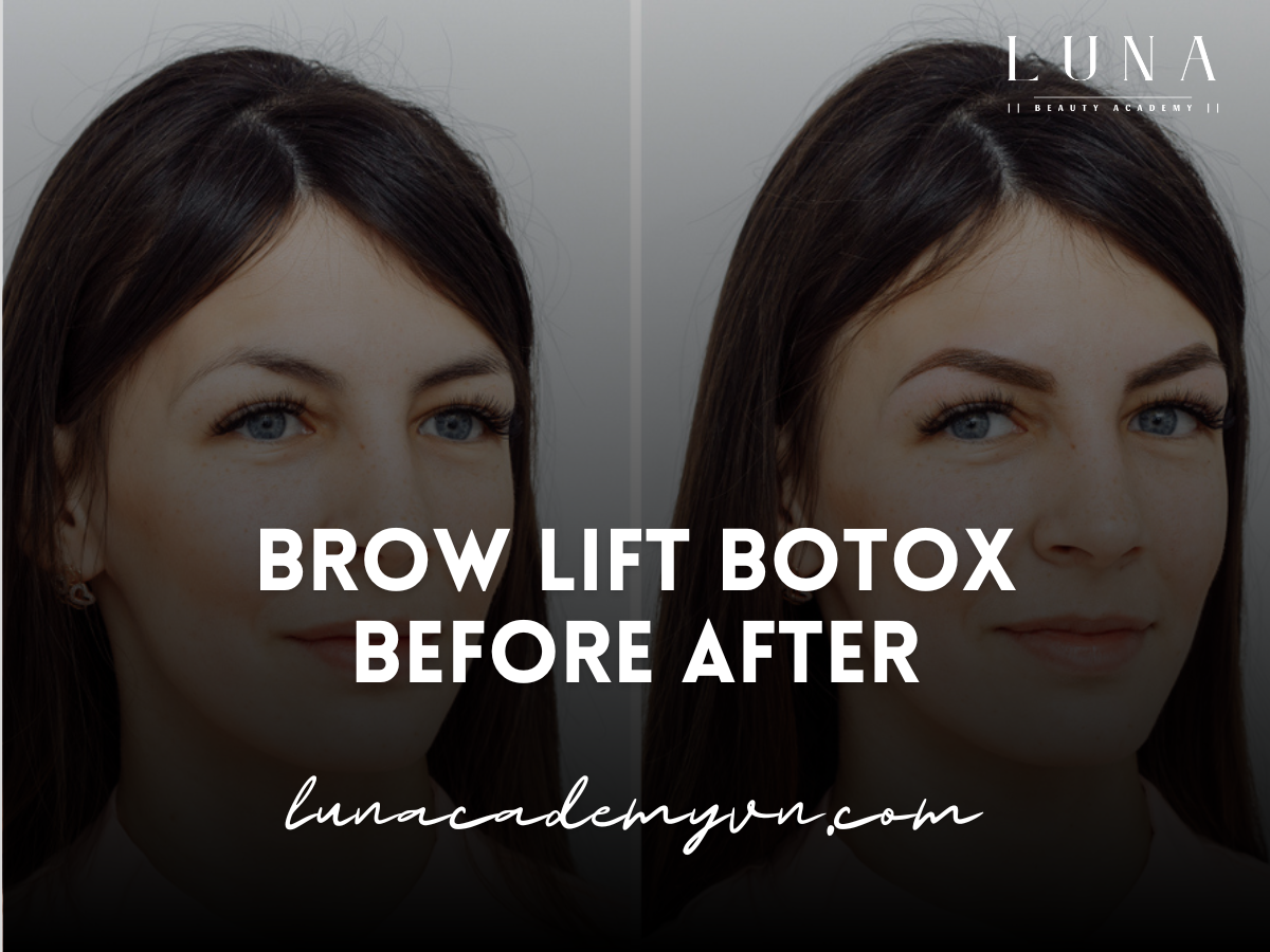 Brow Lift Botox Before After: What to Expect and Key Results