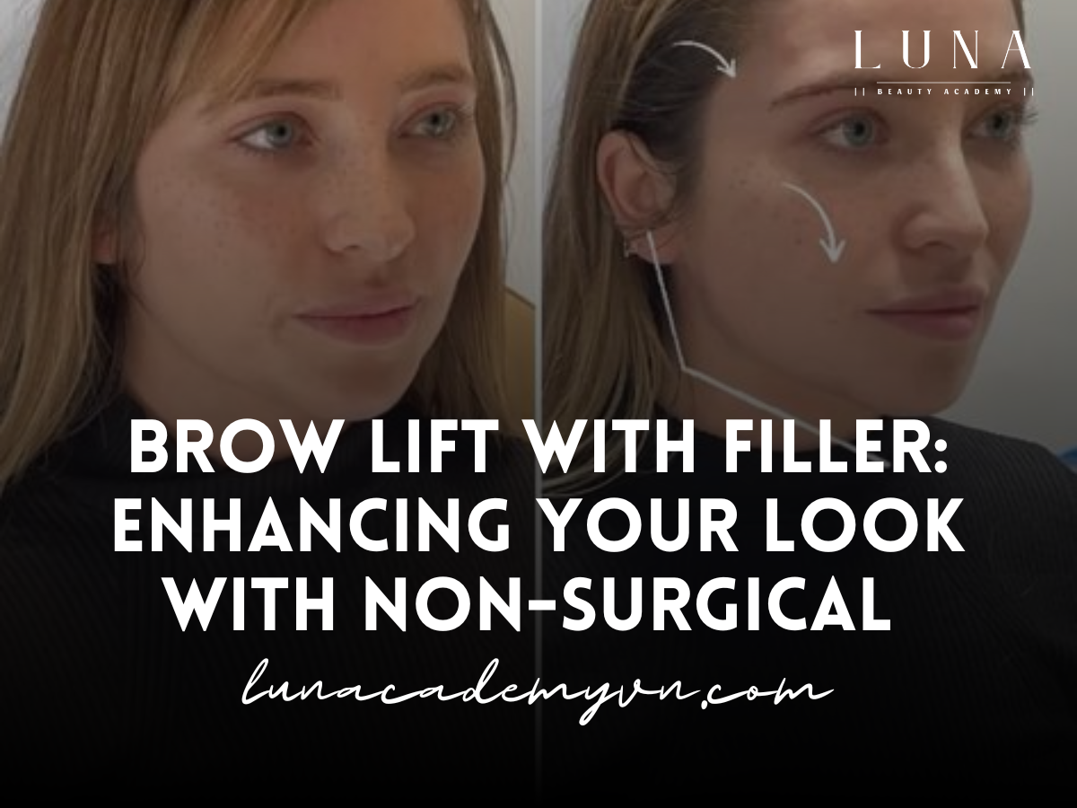 brow lift with filler