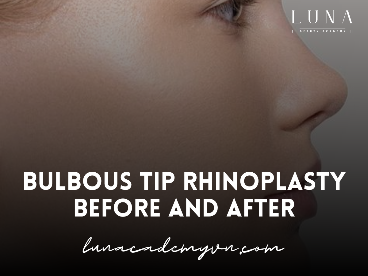 Bulbous Tip Rhinoplasty Before and After